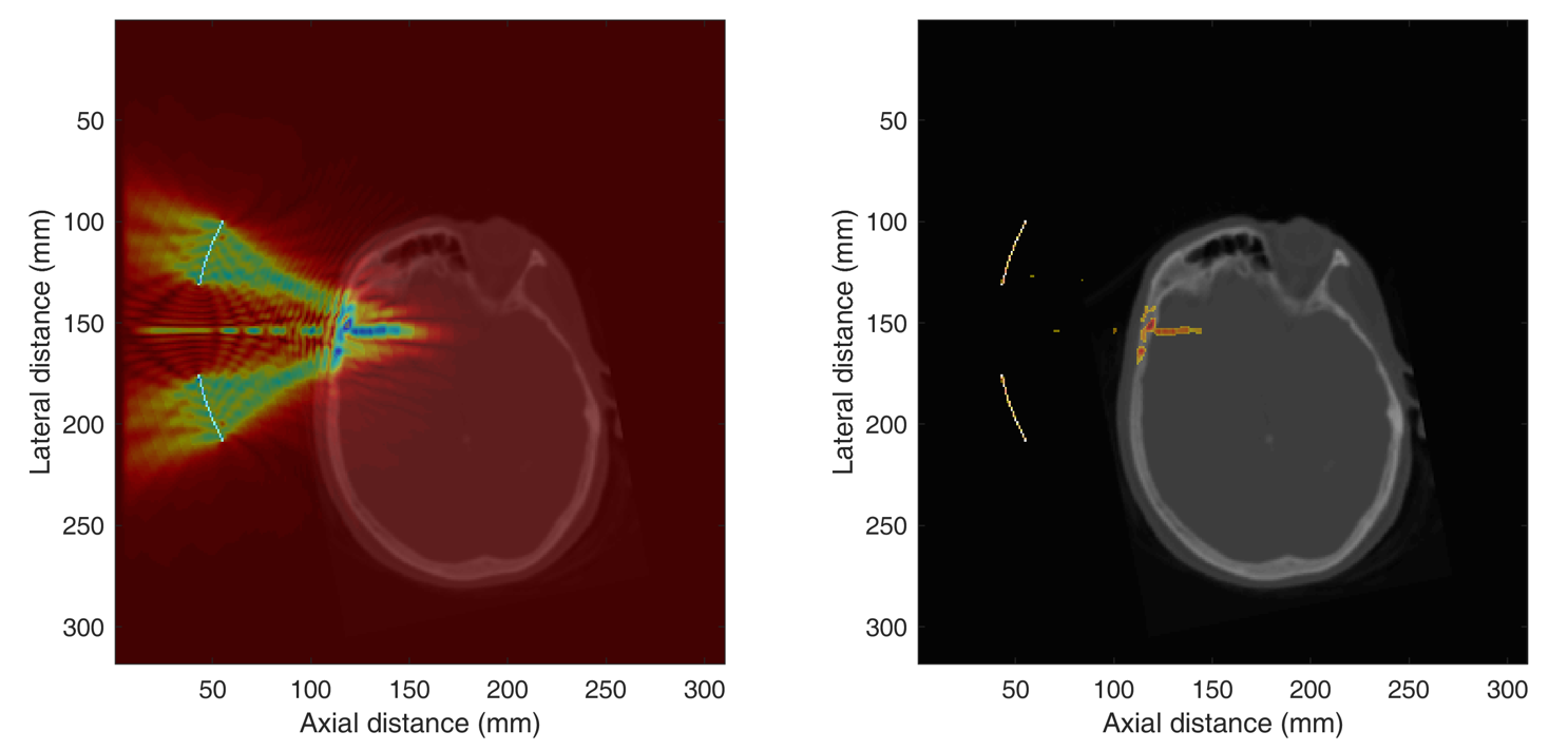 Opening Blood-Brain Barrier With Focused Ultrasound | Mirage News